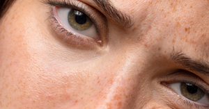 Hiperpigmentacija kože: šta izaziva tamne fleke i kako se izboriti sa njima